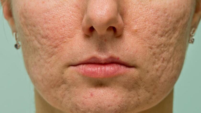 Cicatrici da acne come la carbossiterapia si inserisce in un percorso di trattamento integrato - Dott.ssa Flaminia Crisciotti Medico di Medicina Estetica Rigenerativa Roma
