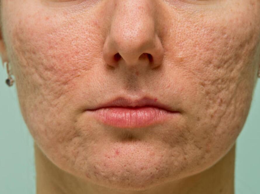 Cicatrici da acne come la carbossiterapia si inserisce in un percorso di trattamento integrato - Dott.ssa Flaminia Crisciotti Medico di Medicina Estetica Rigenerativa Roma