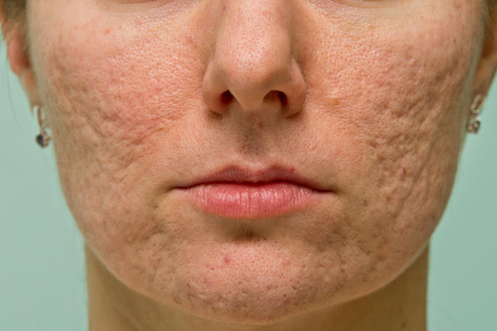 Cicatrici da acne come la carbossiterapia si inserisce in un percorso di trattamento integrato - Dott.ssa Flaminia Crisciotti Medico di Medicina Estetica Rigenerativa Roma