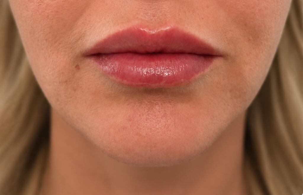 Filler Labbra a Roma Termini - Studio Medico Fanti - Dott.ssa Flaminia Crisciotti Medico Geriatra e Medicina Estetica