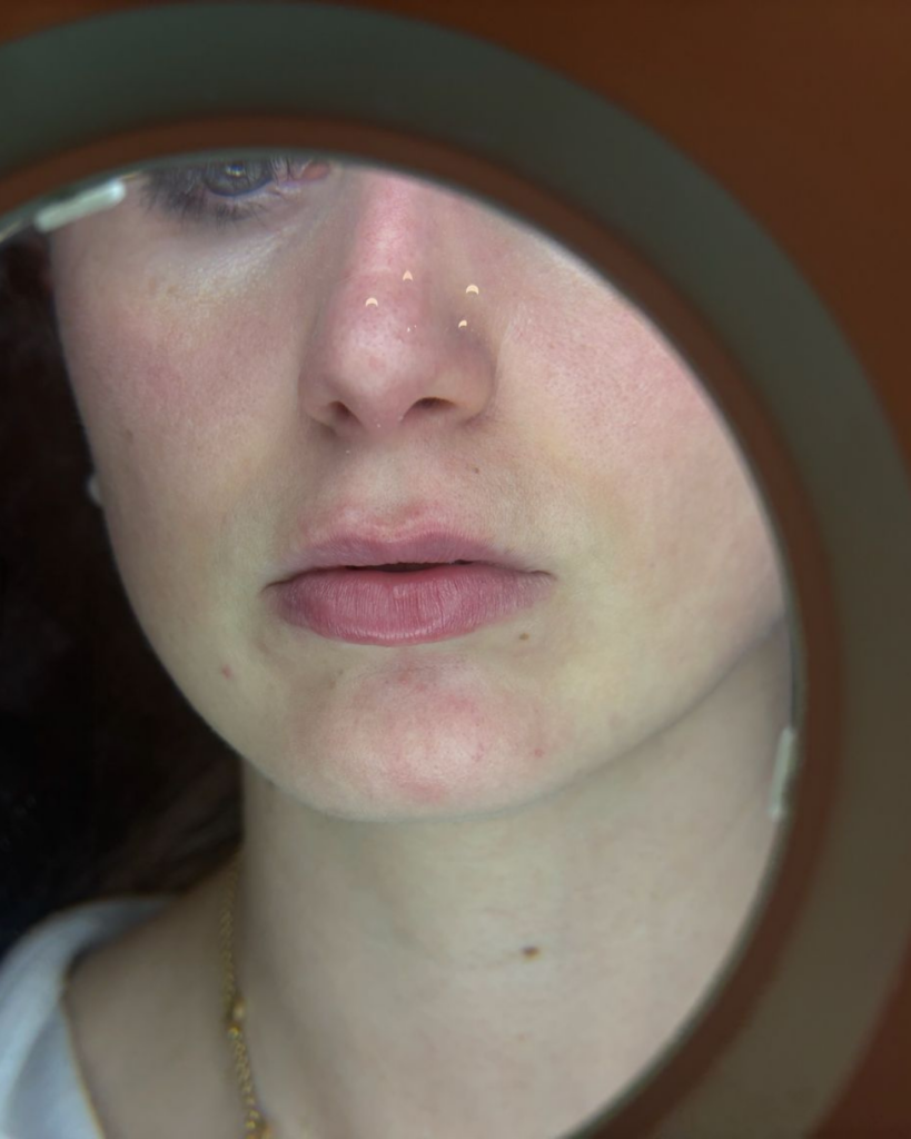 Filler labbra a roma - trattamento medicina estetica - Dott.ssa Flaminia Crisciotti Medico Geriatra e Medicina Estetica