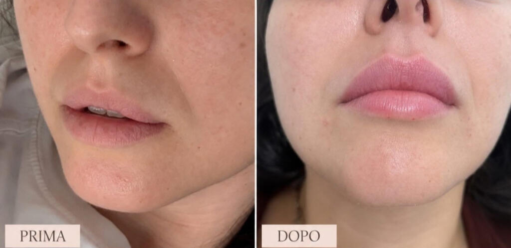 Filler labbra, prima e dopo con risultati naturali