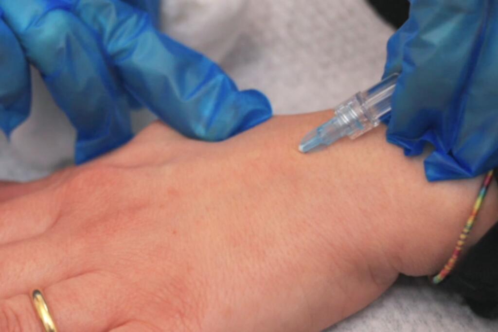 Trattamento carbossiterapia mani - Dott.ssa Flaminia Crisciotti Medico Geriatra e Medicina Estetica