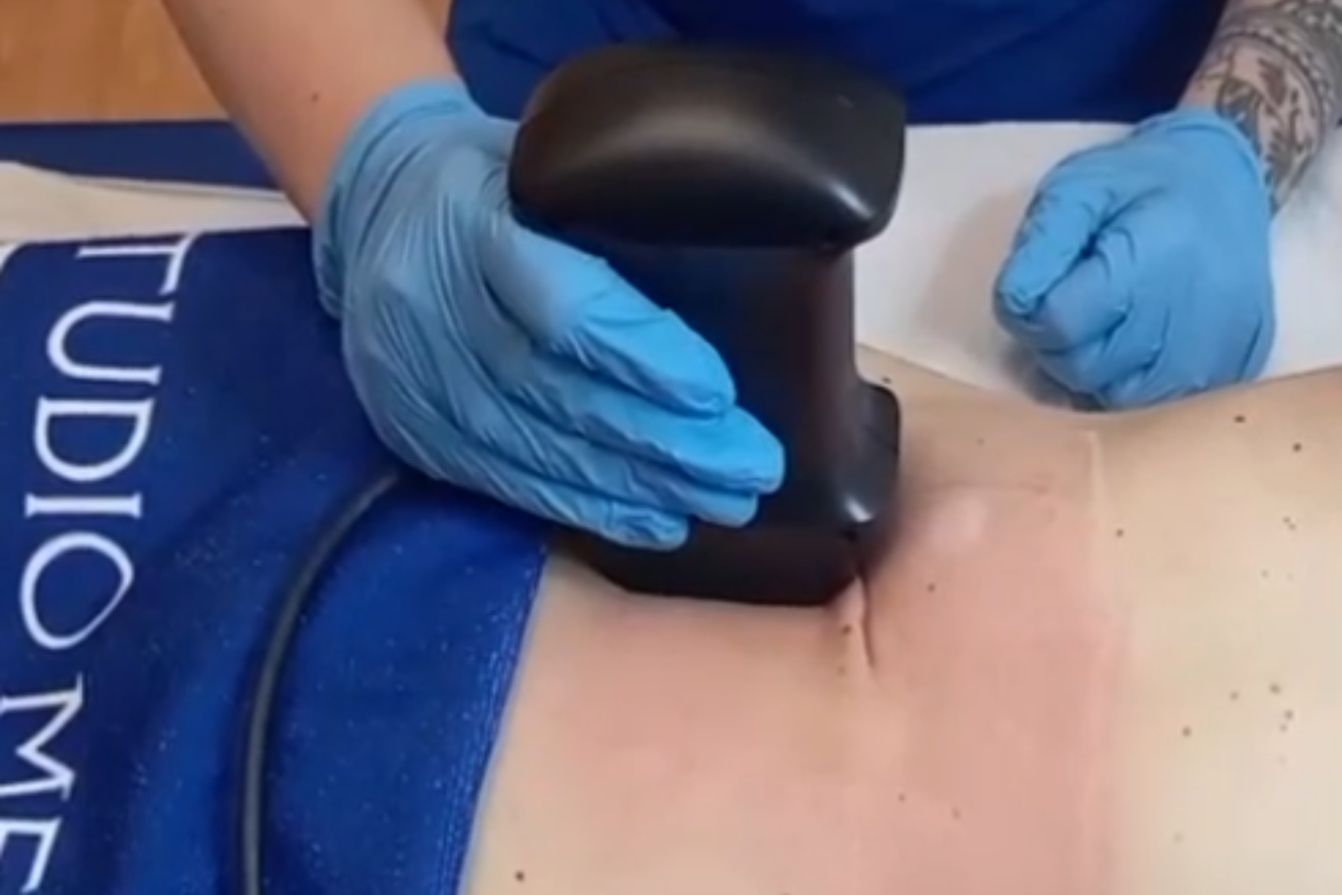 Radiofrequenza corpo BodyFX di Inmode